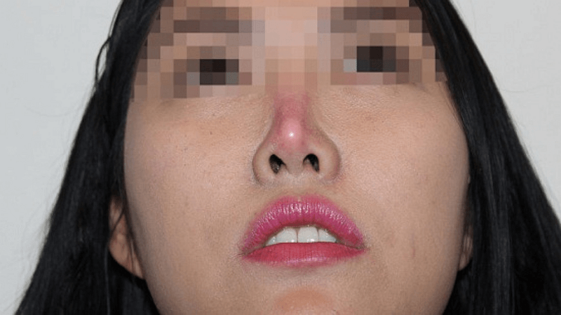 Mũi bị bầm tím và đau kéo dài sau khi phẫu thuật nâng mũi
