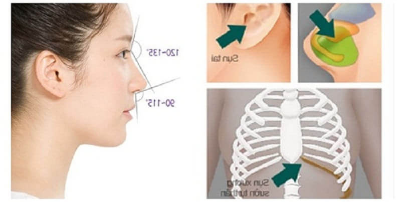 Nâng mũi tự thân dùng sụn trên cơ thể con người như sụn vành tai, sụn vách ngăn và sụn sườn để đưa vào trong mũi