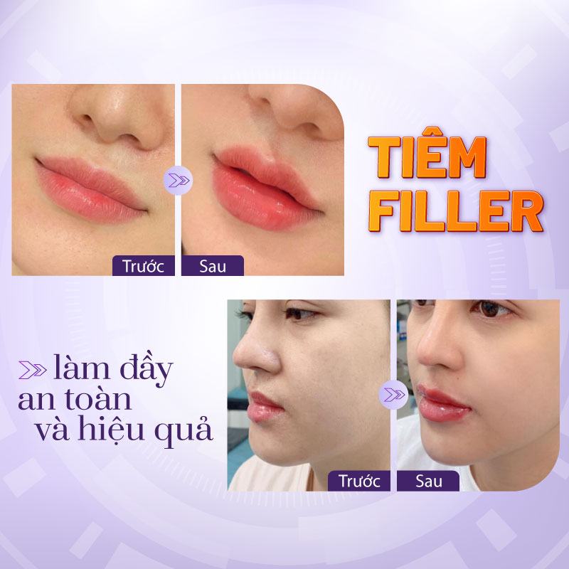 Sự khác nhau giữa tiêm filler botox