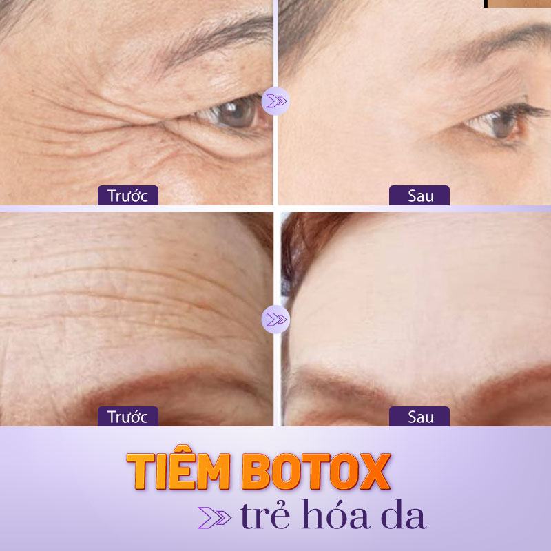 Tiêm filler và botox là gì