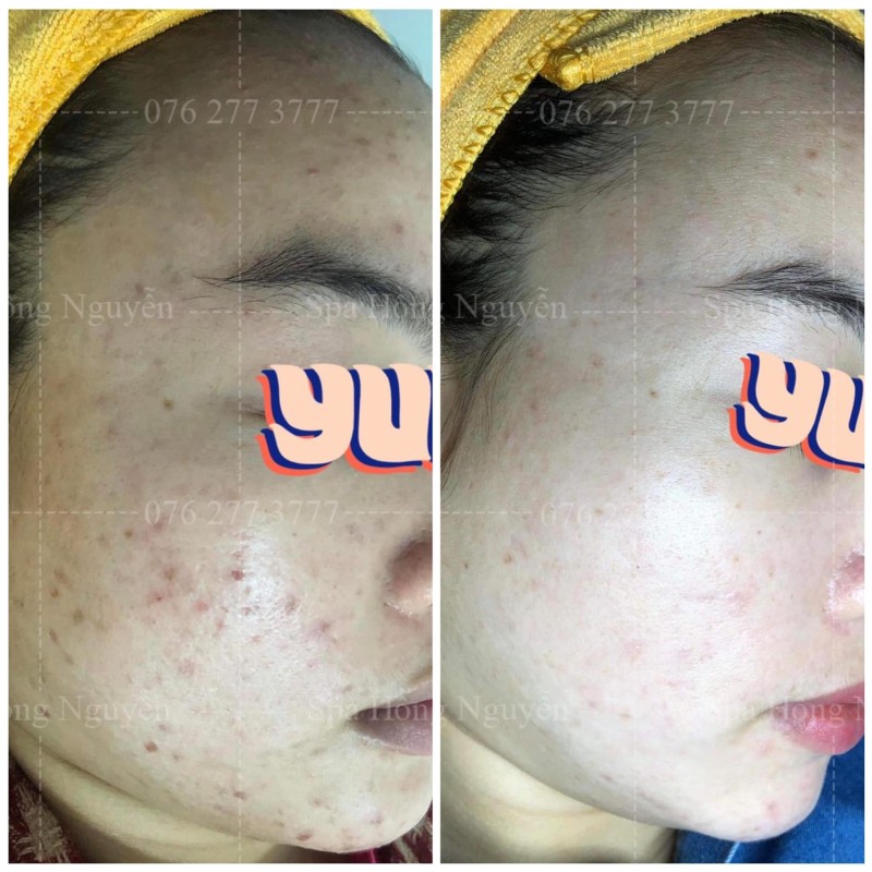 Kết quả điều trị mụn ấn tượng tại Hồng Nguyễn Spa