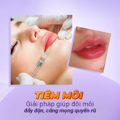 Tiêm môi giá bao nhiêu? Bảng chi phí tiêm filler môi cập nhật năm 2023