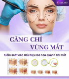 Căng chỉ vùng mắt: Giải pháp trẻ hóa tối ưu cho làn da tươi trẻ