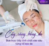 Cấy căng bóng da có tốt không? Duy trì được bao lâu?