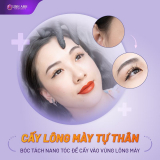 Cấy lông mày tự thân – Làm đẹp lông mày không đau, an toàn