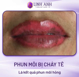 Phun môi bị cháy tê: Nguyên nhân & Cách xử lý an toàn