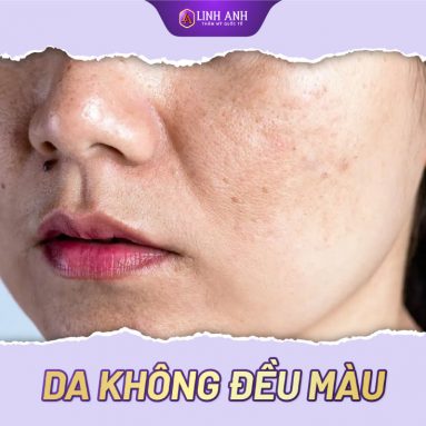 Tại sao da không đều màu? Cách khắc phục da không đều màu