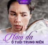 Review TOP 9 kem trị nám cho tuổi 40 hiệu quả nhất hiện nay