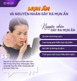 Có nên nặn mụn ẩn không? Cách trị mụn ẩn an toàn hiệu quả