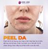 Peel da là gì? Peel da có tốt không? Có nên peel da tại nhà