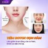 Review tiêm botox gọn hàm – Những sự thật bạn cần biết