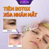 Tiêm Botox xoá nhăn mắt có thực sự hiệu quả?