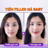 Tiêm Filler má baby giữ được bao lâu? Bảng giá cập nhật mới nhất 2024